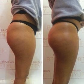 Brazilian Butt Lift, Preston Aesthetic Clinic, Be Beautiful